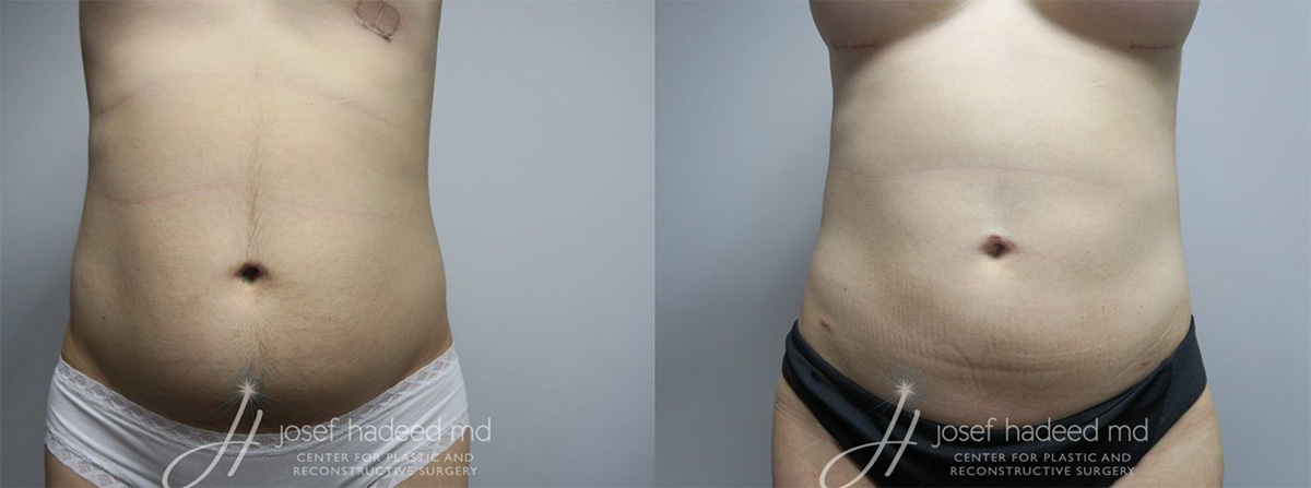Liposuction before and after