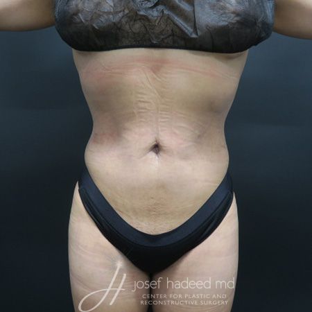 Case--6473 | After Rib Remodeling