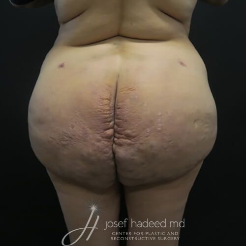 Silicone-Injection-Removal--3530 | After Silicone Injection Removal