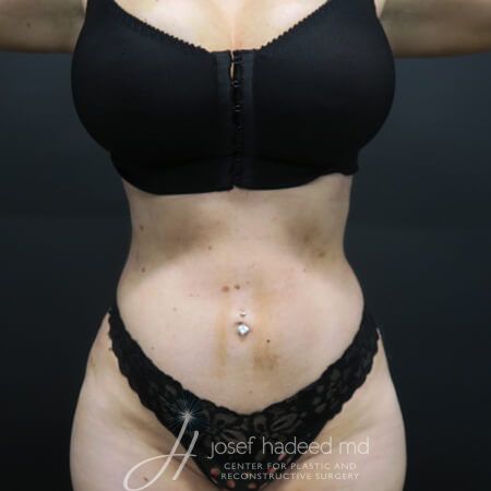 Rib-Remodeling--5811 | After Rib Remodeling