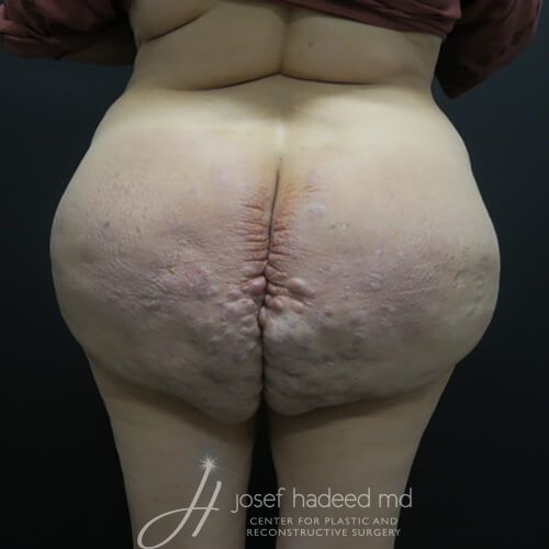 Silicone-Injection-Removal--3530 | Before Silicone Injection Removal