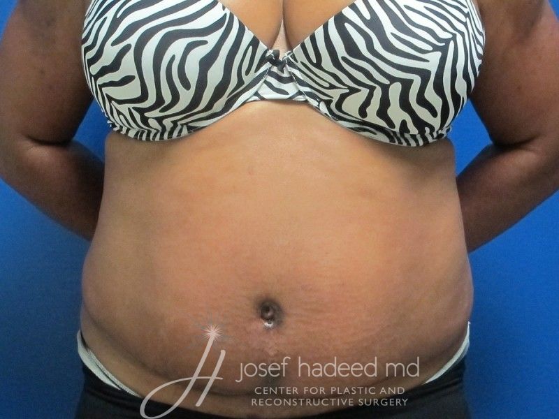 Tummy-Tuck--4312 | After Tummy Tuck