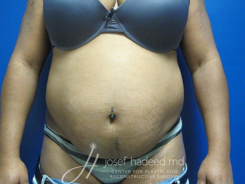 Tummy-Tuck--4312 | Before Tummy Tuck