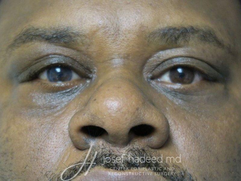 Blepharoplasty--5913 | After Blepharoplasty