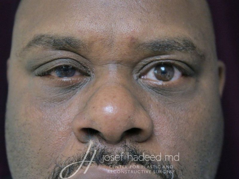 Blepharoplasty--5913 | Before Blepharoplasty