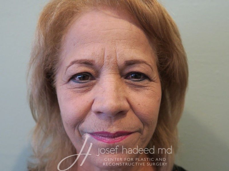 Blepharoplasty--3872 | Before Blepharoplasty