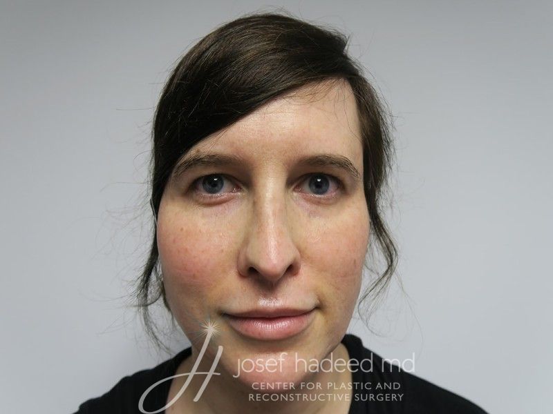 Blepharoplasty--9821 | Before Blepharoplasty