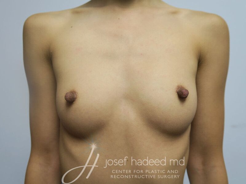 Breast-Augmentation-Case--4852 | Before Breast Augmentation