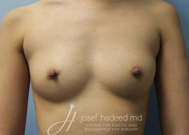 Breast-Augmentation--7867 | Before Breast Augmentation