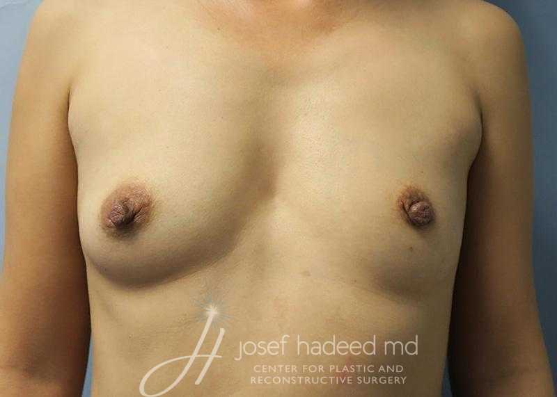 Breast-Augmentation--4639 | Before Breast Augmentation