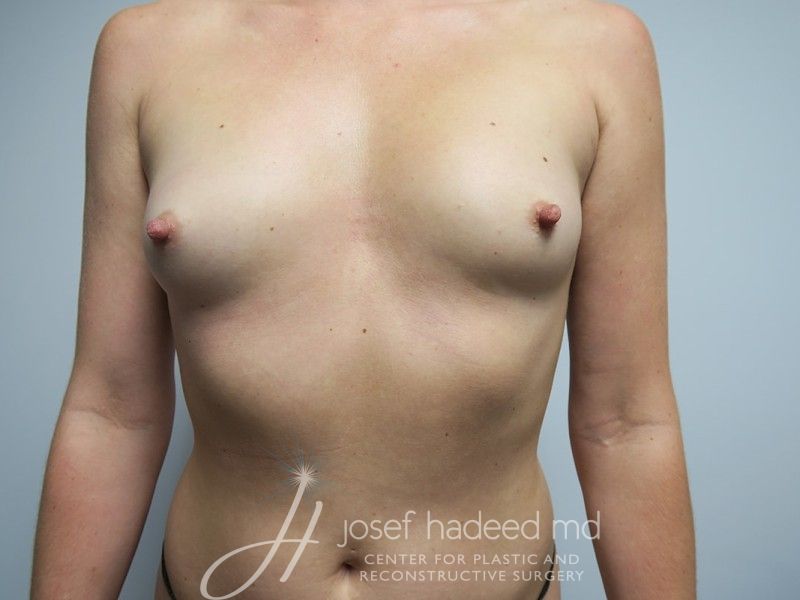 breast-aug-22-010a-before