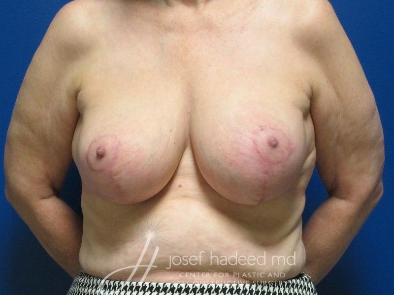 breast-reduction-22-001a-after