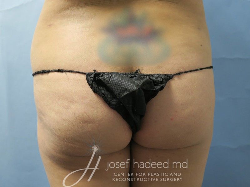 Buttock-Lift--0252 | Before Buttock Lift