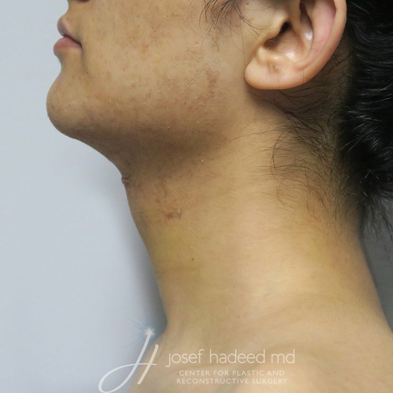 facial-feminization-22-001a-after