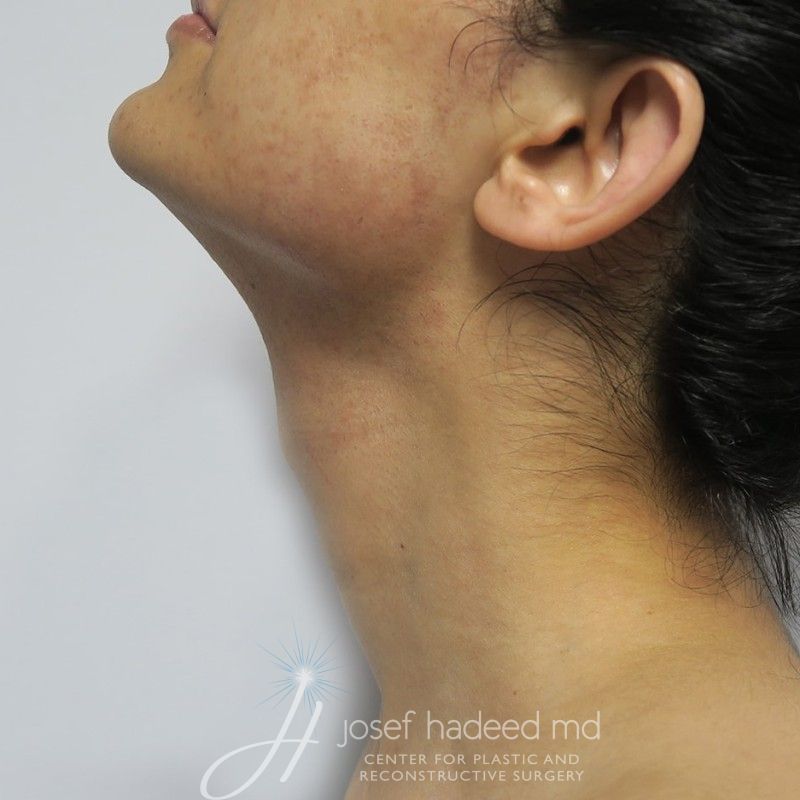 facial-feminization-22-001a-before