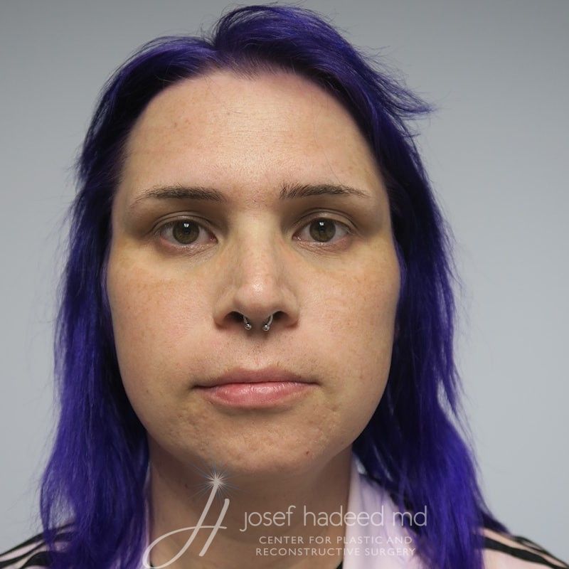 facial-feminization-22-002a-before