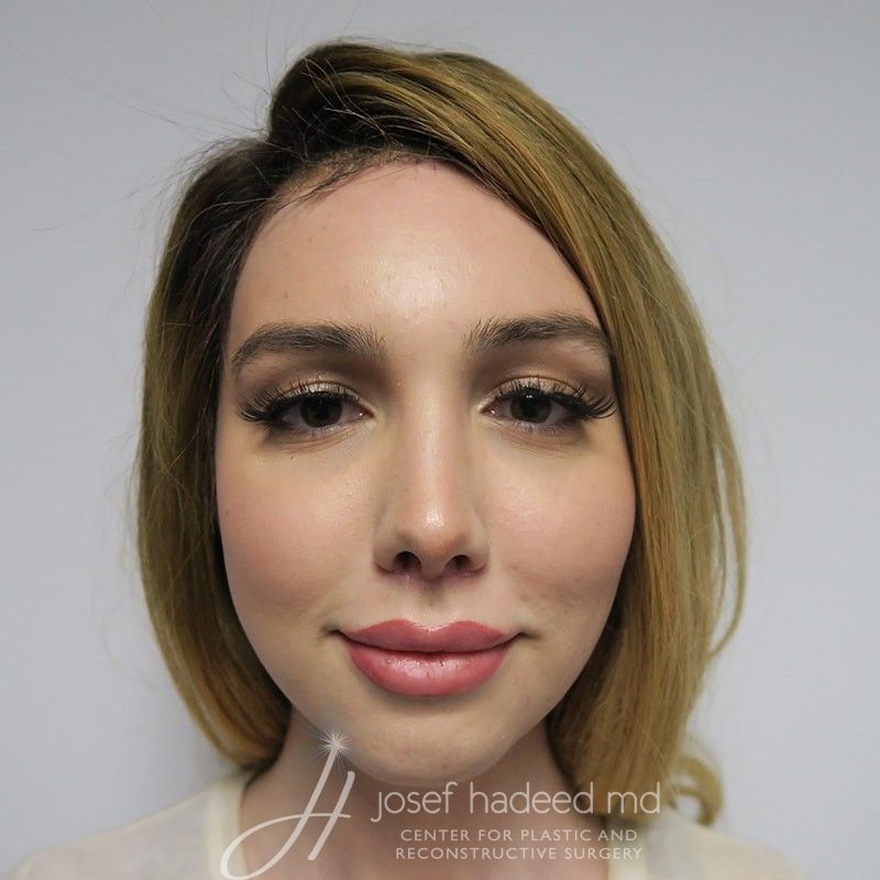 facial-feminization-22-004a-after