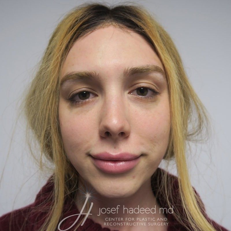 facial-feminization-22-004a-before