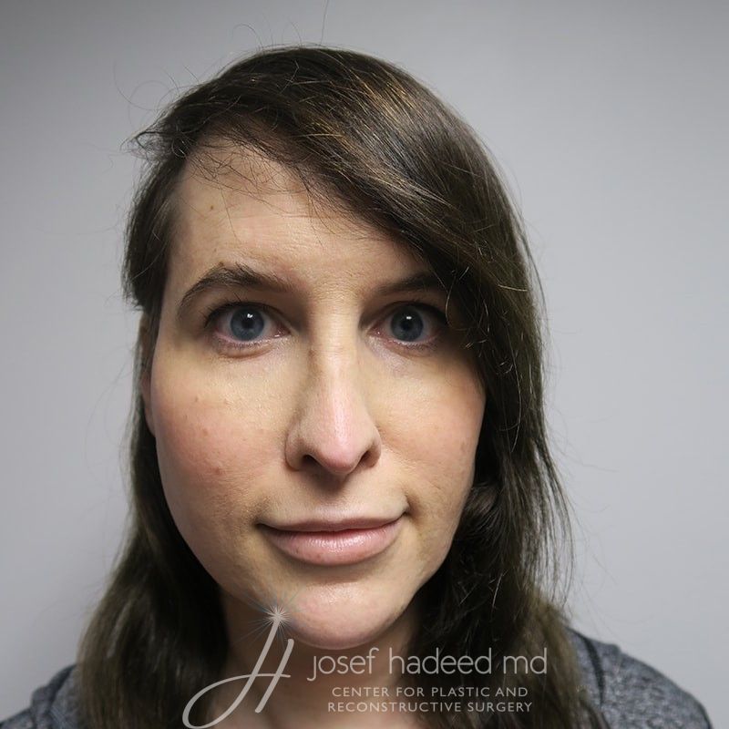 facial-feminization-22-006a-after