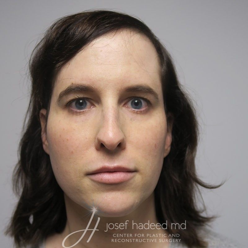 facial-feminization-22-006a-before