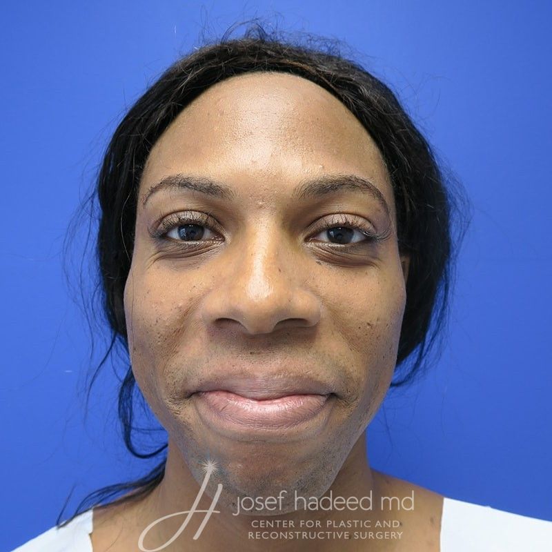 facial-feminization-22-007a-before