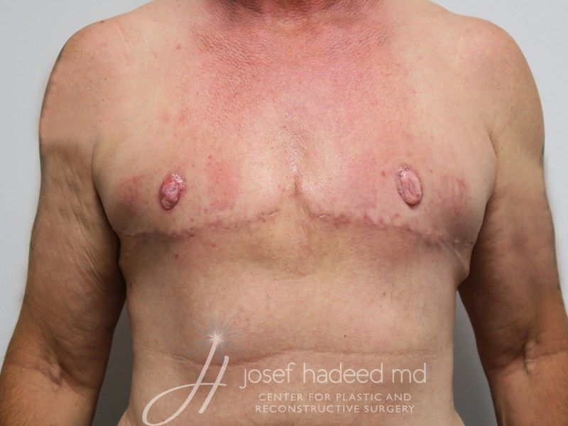 FTM-Top-Surgery--9086 | After FTM Top Surgery