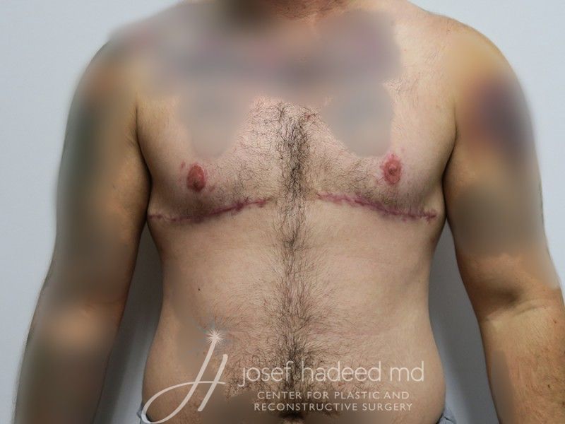 FTM-Top-Surgery--6171 | After FTM Top Surgery