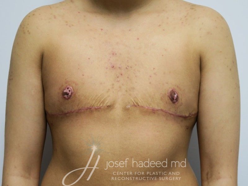 ftm-top-surgery-22-003a-after