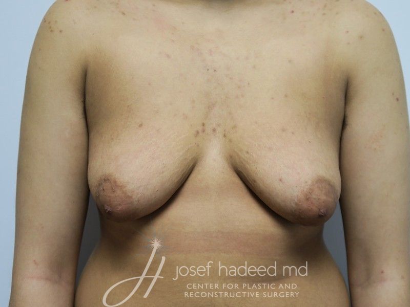 ftm-top-surgery-22-003a-before