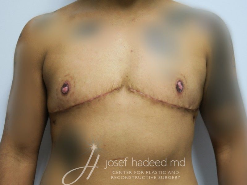 FTM-Top-Surgery--4027 | After FTM Top Surgery