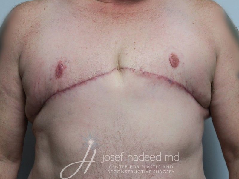 FTM-Top-Surgery--1110 | After FTM Top Surgery