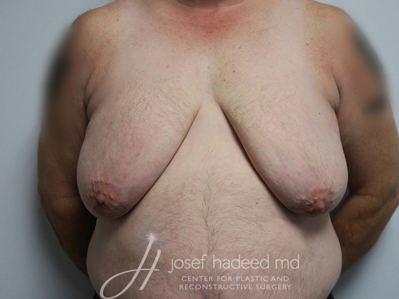 FTM-Top-Surgery--1110 | Before FTM Top Surgery