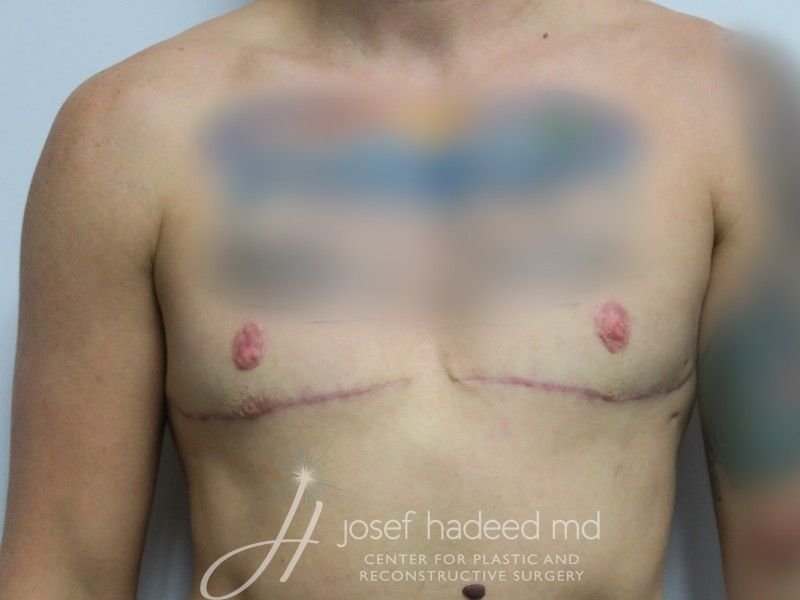 FTM-Top-Surgery--7729 | After FTM Top Surgery