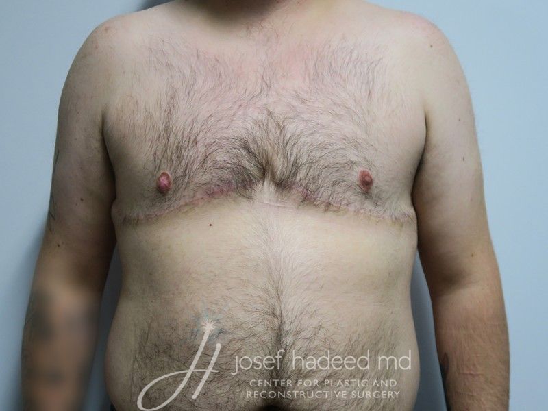 FTM-Top-Surgery--7399 | After FTM Top Surgery