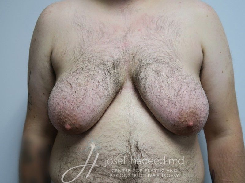 FTM-Top-Surgery--7399 | Before FTM Top Surgery