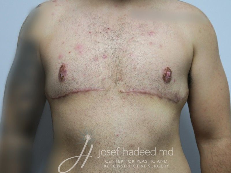 FTM-Top-Surgery--8769 | After FTM Top Surgery