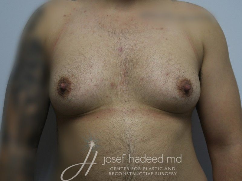 FTM-Top-Surgery--8769 | Before FTM Top Surgery