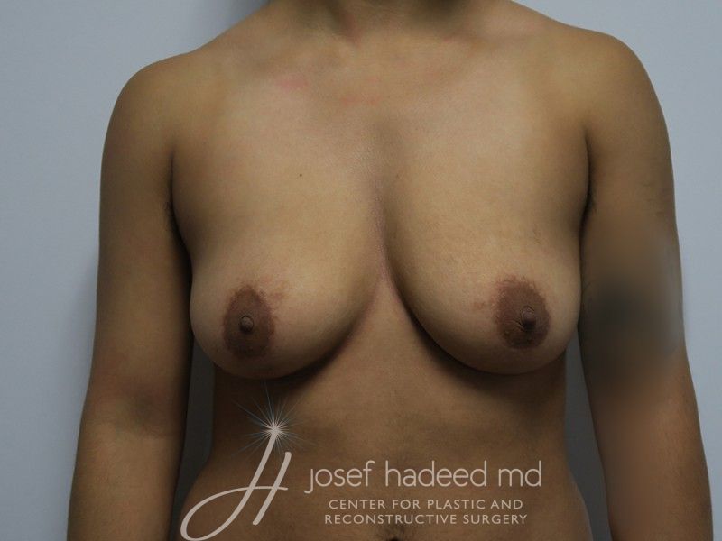 FTM-Top-Surgery--8682 | Before FTM Top Surgery