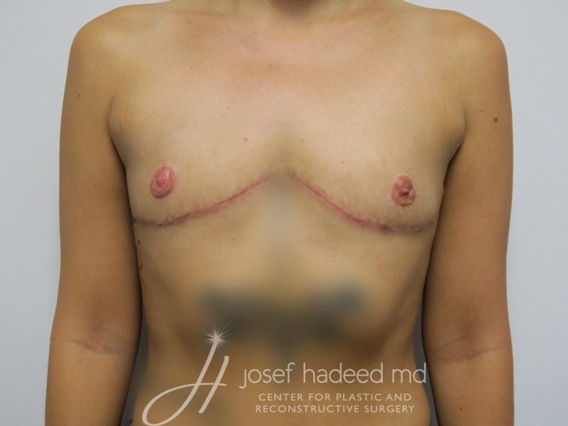 FTM-Top-Surgery--1126 | After FTM Top Surgery