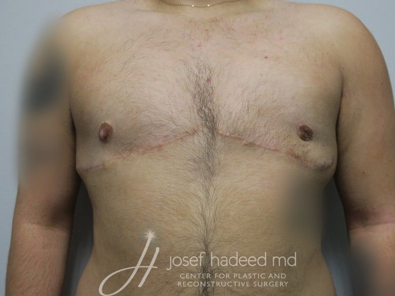 FTM-Top-Surgery--3190 | After FTM Top Surgery