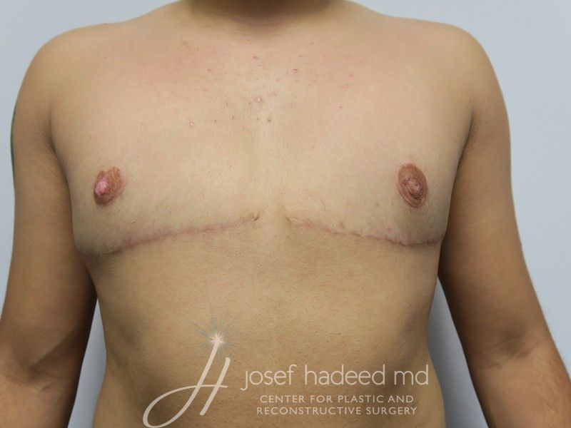 FTM-Top-Surgery--5237 | After FTM Top Surgery