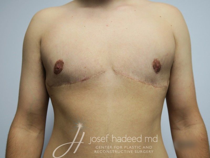 FTM-Top-Surgery--1076 | After FTM Top Surgery