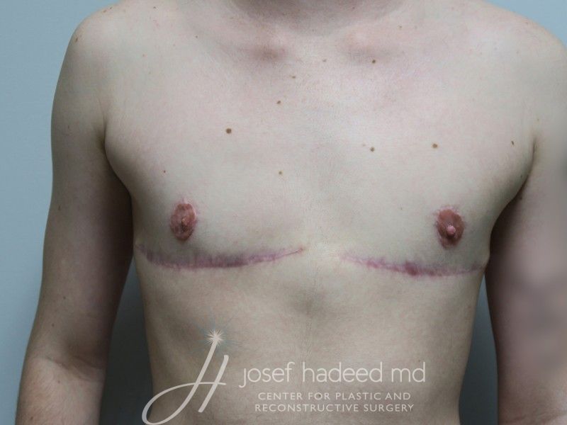 FTM-Top-Surgery--2236 | After FTM Top Surgery