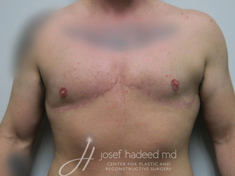 FTM-Top-Surgery--7334 | After FTM Top Surgery