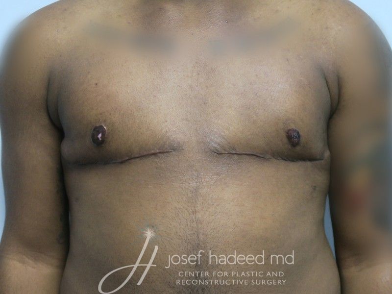 FTM-Top-Surgery--7302 | After FTM Top Surgery