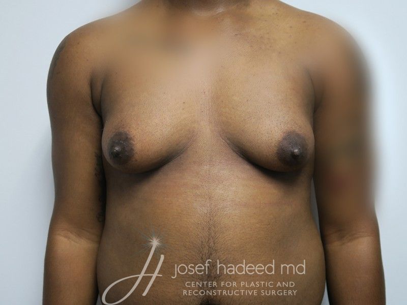 FTM-Top-Surgery--7302 | Before FTM Top Surgery