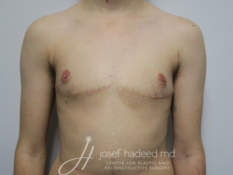 ftm-top-surgery-22-019a-after