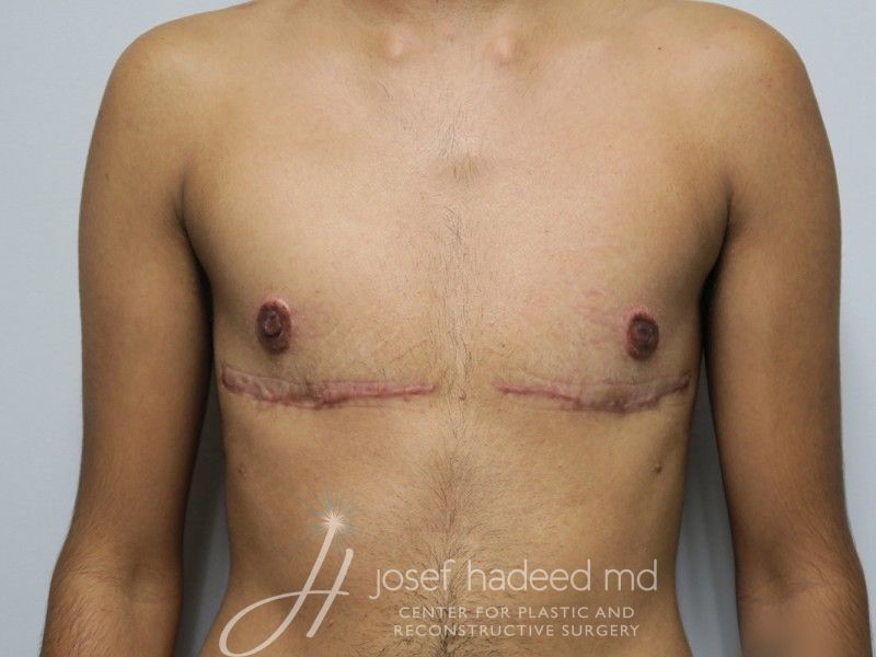 FTM-Top-Surgery--6027 | After FTM Top Surgery