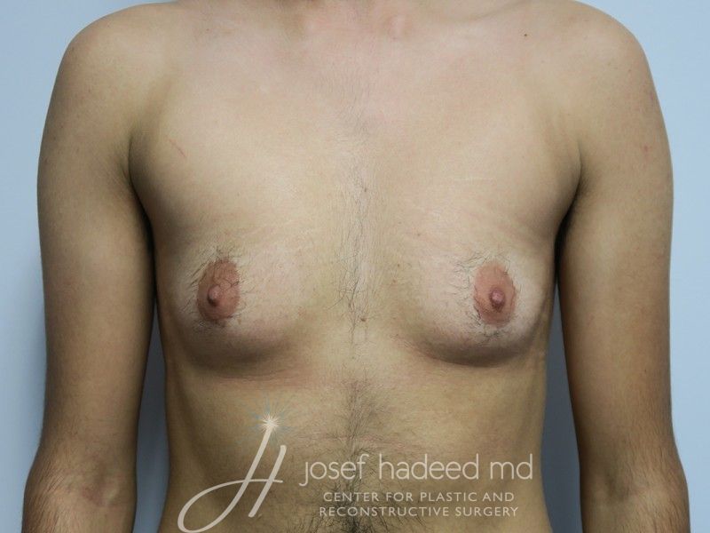 FTM-Top-Surgery--6027 | Before FTM Top Surgery