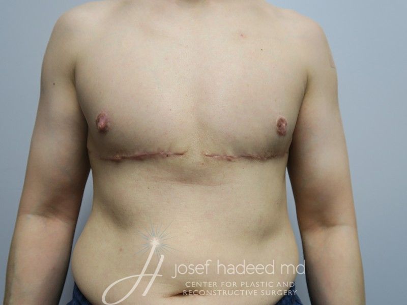 FTM-Top-Surgery--1502 | After FTM Top Surgery